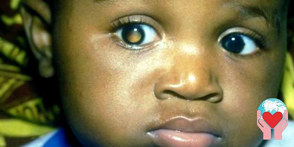 retinoblastoma bambini congo